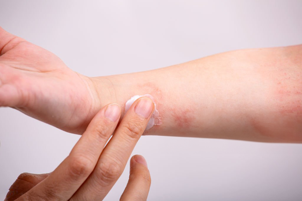 Dermatitis atópica: rutina de cuidado de la piel